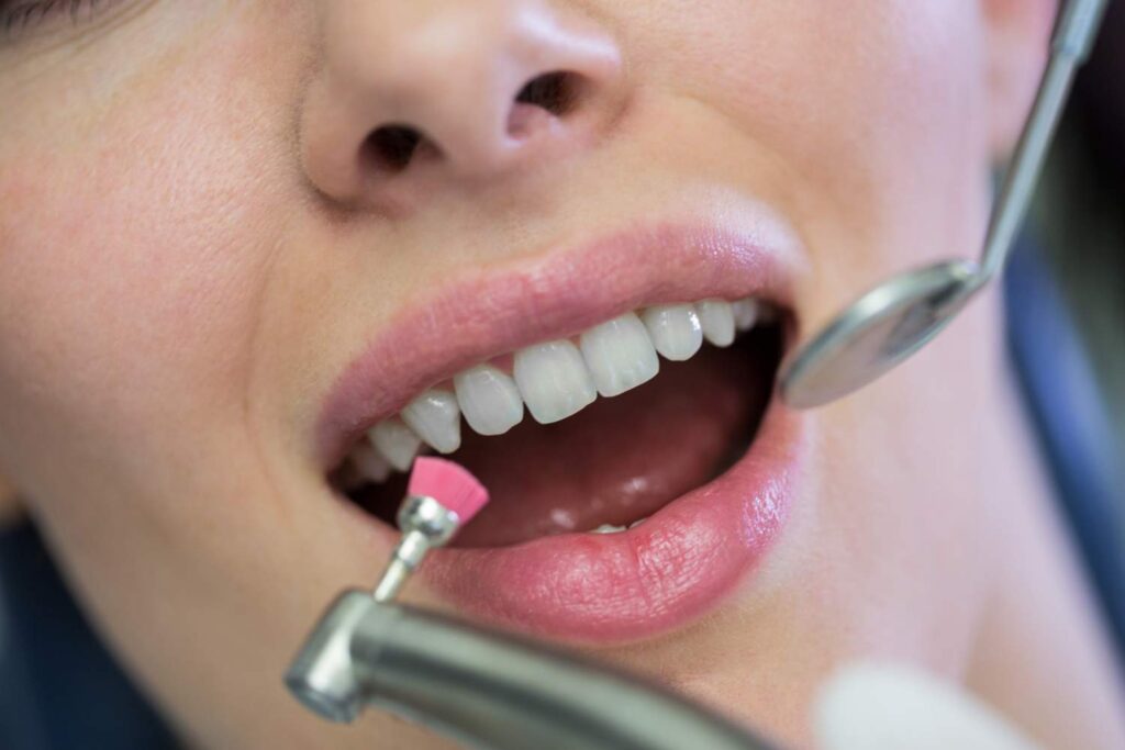 Pulido de los dientes con un espejo dental durante una limpieza profesional