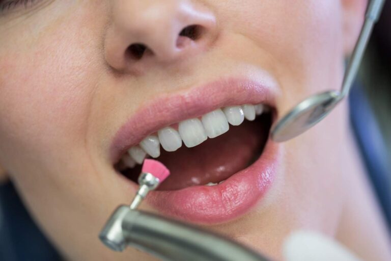 Pulido de los dientes con un espejo dental durante una limpieza profesional