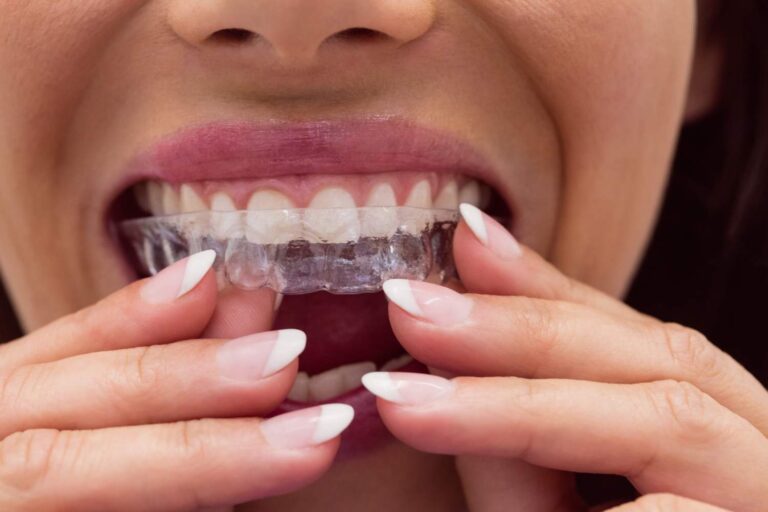 Mujer colocándose un alineador transparente de ortodoncia invisible